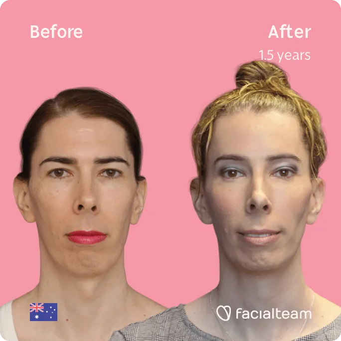 Square frontal image of FFS patient Ella showing the results before and after facial feminization surgery with Facialteam consisting of forehead, tracheal shave, jaw and chin feminization surgery.