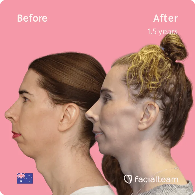 Square Side image of FFS patient Ella showing the results before and after facial feminization surgery with Facialteam consisting of forehead, tracheal shave, jaw and chin feminization surgery.