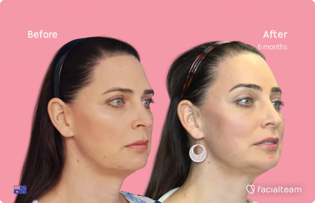 45 degree image of FFS patient Savannah showing the results before and after facial feminization surgery consisting of forehead, tracheal shave, jaw and chin feminization surgery.