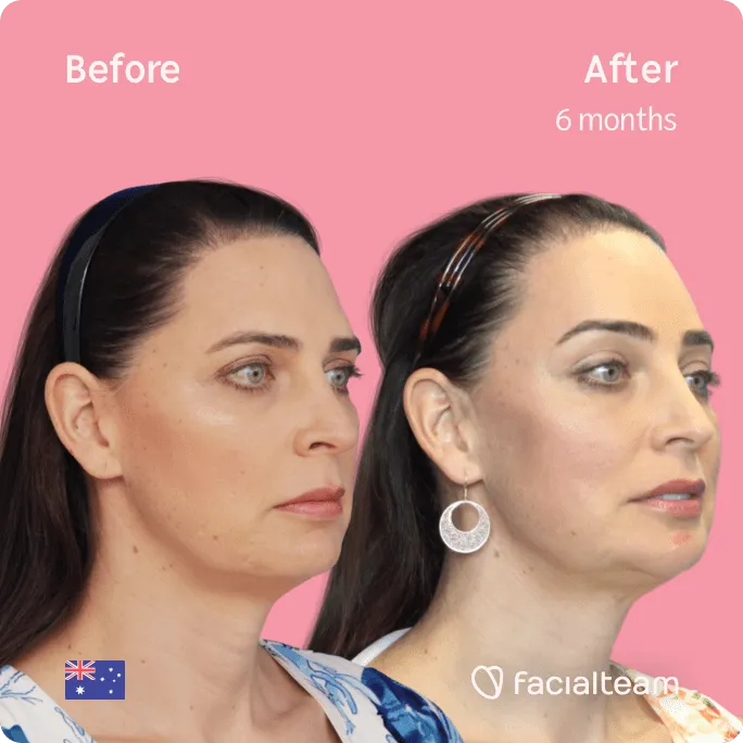 Square 45 degree image of FFS patient Savannah showing the results before and after facial feminization surgery consisting of forehead, tracheal shave, jaw and chin feminization surgery.