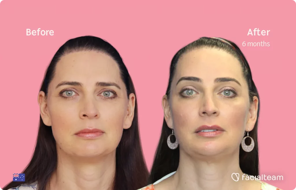 Frontal image of FFS patient Savannah showing the results before and after facial feminization surgery with Facialteam consisting of forehead, tracheal shave, jaw and chin feminization surgery.