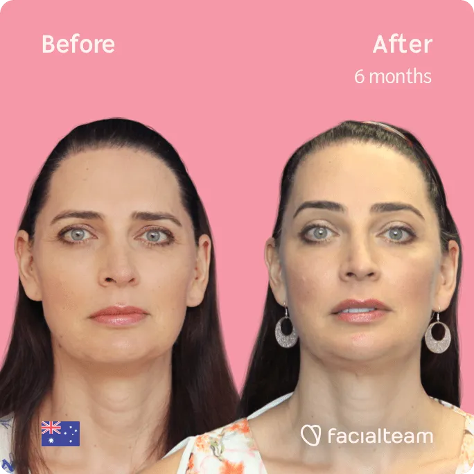 Square frontal image of FFS patient Savannah showing the results before and after facial feminization surgery with Facialteam consisting of forehead, tracheal shave, jaw and chin feminization surgery.