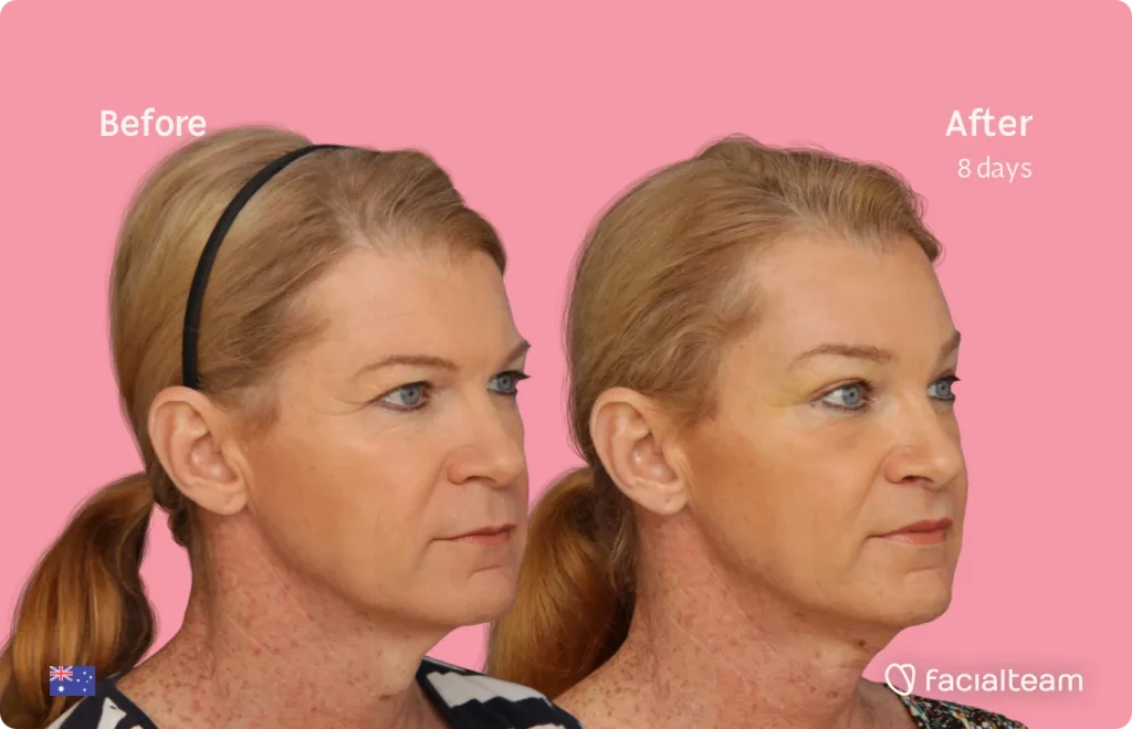 45 degree image of FFS patient Kelly showing the results before and after facial feminization surgery consisting of forehead, tracheal shave, lip feminization surgery.