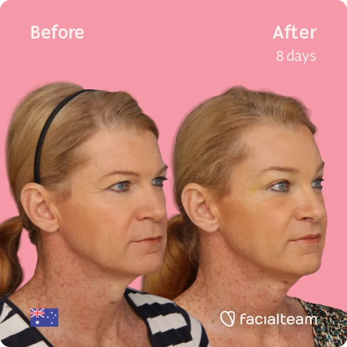Square 45 degree image of FFS patient Kelly showing the results before and after facial feminization surgery consisting of forehead, tracheal shave, lip feminization surgery.