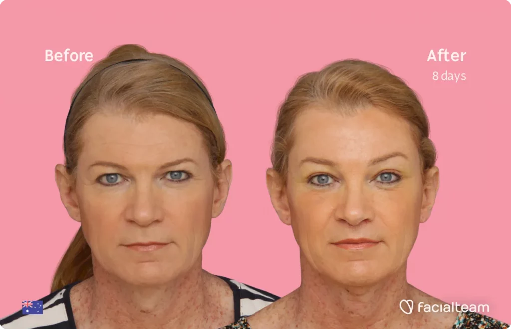 Frontal image of FFS patient Kelly showing the results before and after facial feminization surgery with Facialteam consisting of forehead, tracheal shave, lip feminization surgery.