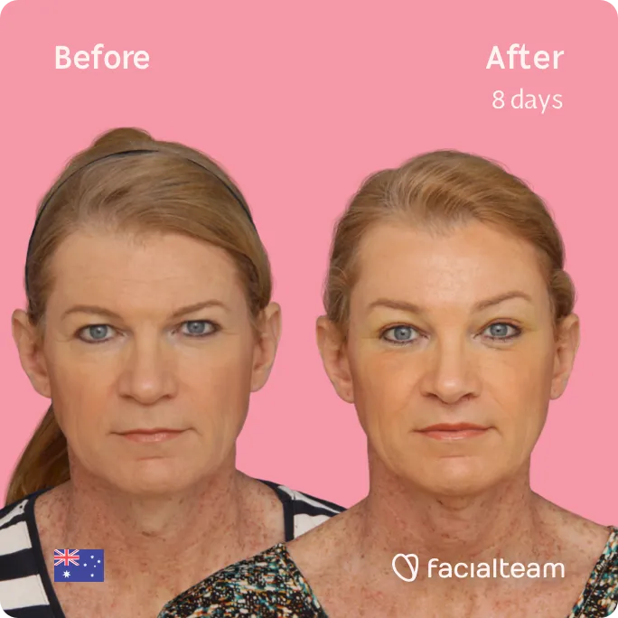 Square frontal image of FFS patient Kelly showing the results before and after facial feminization surgery with Facialteam consisting of forehead, tracheal shave, lip feminization surgery.