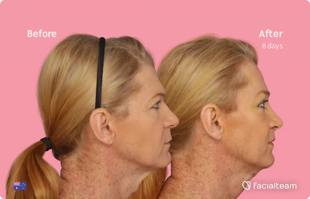Side image of FFS patient Kelly showing the results before and after facial feminization surgery with Facialteam consisting of forehead, tracheal shave, lip feminization surgery.