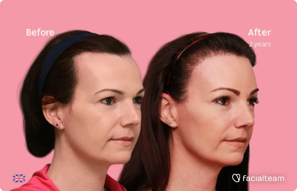 45 degree image of FFS patient Phoebe showing the results before and after facial feminization surgery consisting of forehead, tracheal shave, lip feminization surgery.