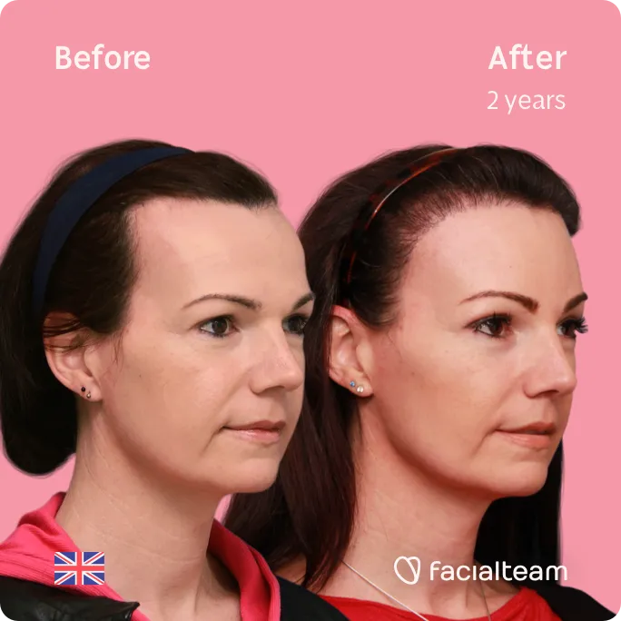 Square 45 degree image of FFS patient Phoebe showing the results before and after facial feminization surgery consisting of forehead, tracheal shave, lip feminization surgery.