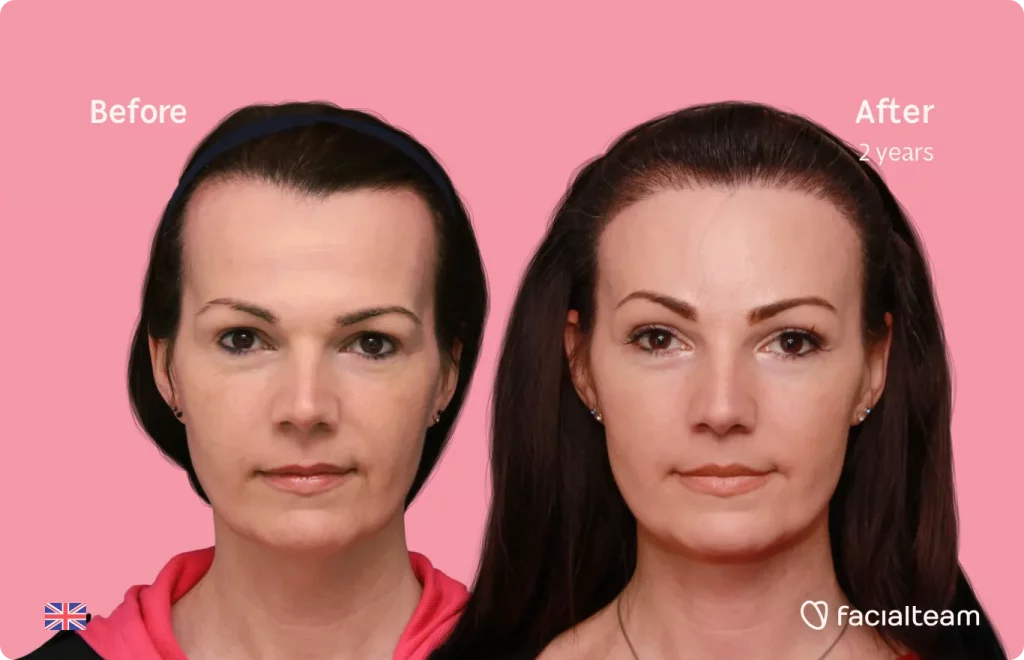 Frontal image of FFS patient Phoebe showing the results before and after facial feminization surgery with Facialteam consisting of forehead, tracheal shave, lip feminization surgery.