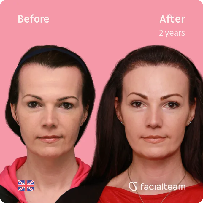 Square frontal image of FFS patient Phoebe showing the results before and after facial feminization surgery with Facialteam consisting of forehead, tracheal shave, lip feminization surgery.
