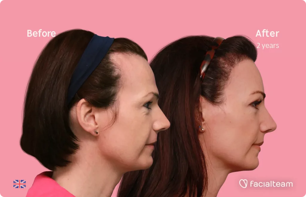 Side image of FFS patient Phoebe showing the results before and after facial feminization surgery with Facialteam consisting of forehead, tracheal shave, lip feminization surgery.