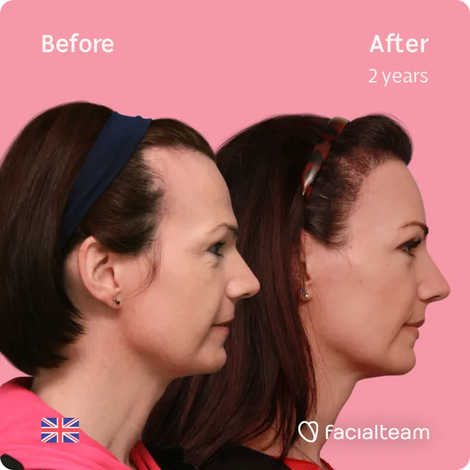 Square Side image of FFS patient Phoebe showing the results before and after facial feminization surgery with Facialteam consisting of forehead, tracheal shave, lip feminization surgery.