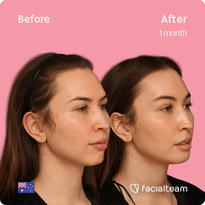 Square 45 degree image of FFS patient Bhenji showing the results before and after facial feminization surgery consisting of jaw and chin feminization surgery.