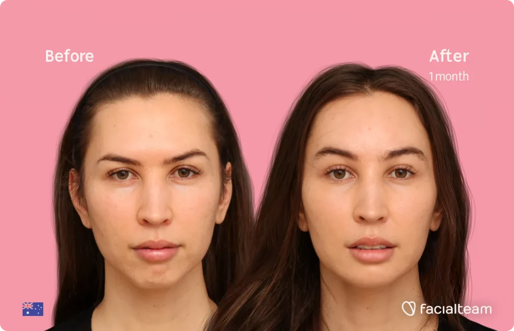Frontal image of FFS patient Bhenji showing the results before and after facial feminization surgery with Facialteam consisting of jaw and chin feminization surgery.