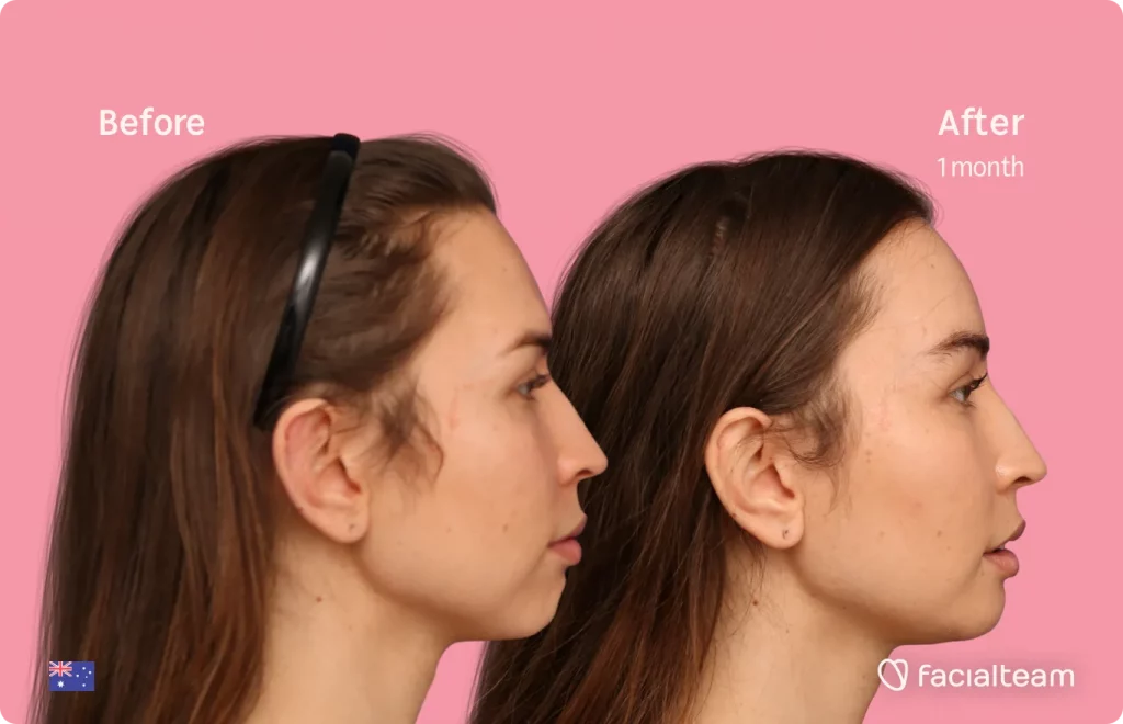 Side image of FFS patient Bhenji showing the results before and after facial feminization surgery with Facialteam consisting of jaw and chin feminization surgery.