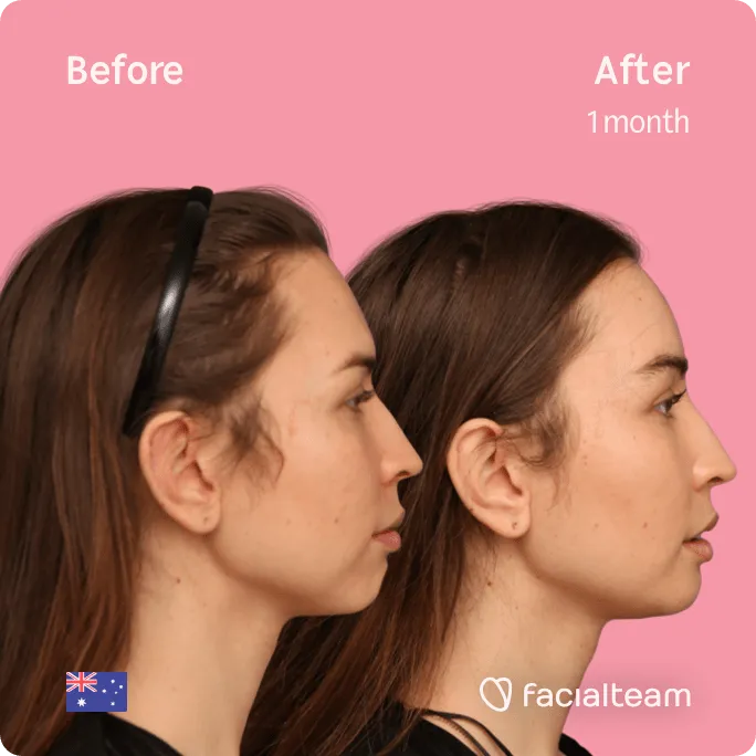 Square Side image of FFS patient Bhenji showing the results before and after facial feminization surgery with Facialteam consisting of jaw and chin feminization surgery.