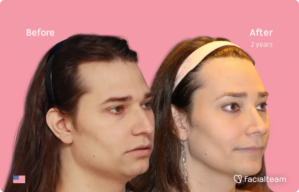 45 degree image of FFS patient Lexi showing the results before and after facial feminization surgery consisting of jaw and chin, forehead, rhinoplasty feminization surgery.