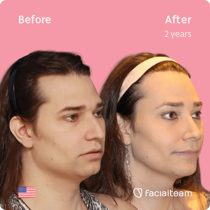 Square 45 degree image of FFS patient Lexi showing the results before and after facial feminization surgery consisting of jaw and chin, forehead, rhinoplasty feminization surgery.