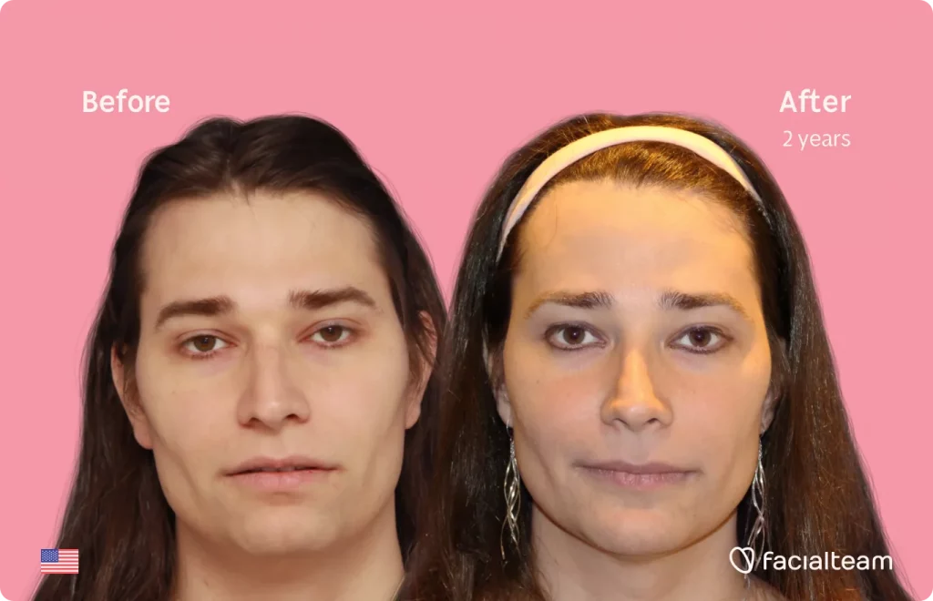 Frontal image of FFS patient Lexi showing the results before and after facial feminization surgery with Facialteam consisting of jaw and chin, forehead, rhinoplasty feminization surgery.