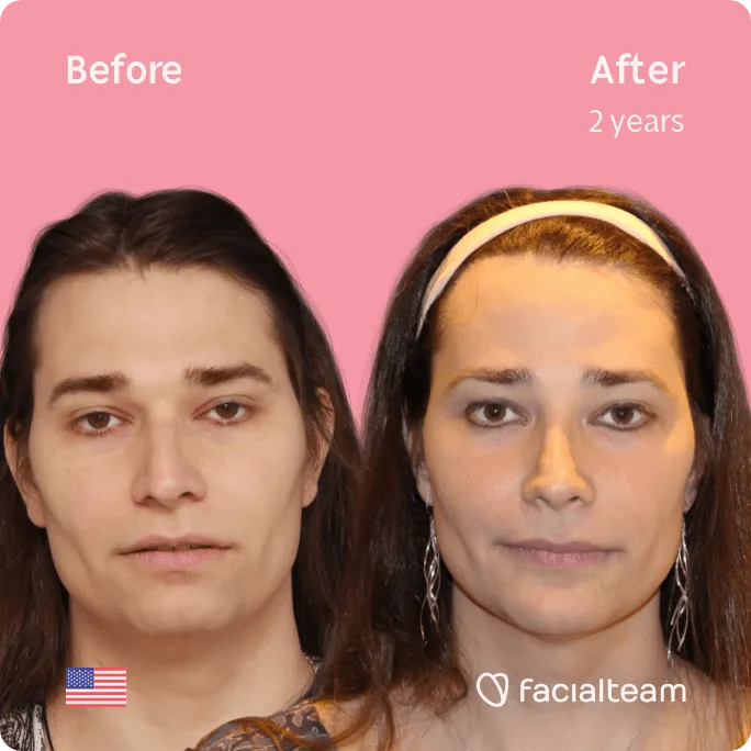 Square frontal image of FFS patient Lexi showing the results before and after facial feminization surgery with Facialteam consisting of jaw and chin, forehead, rhinoplasty feminization surgery.