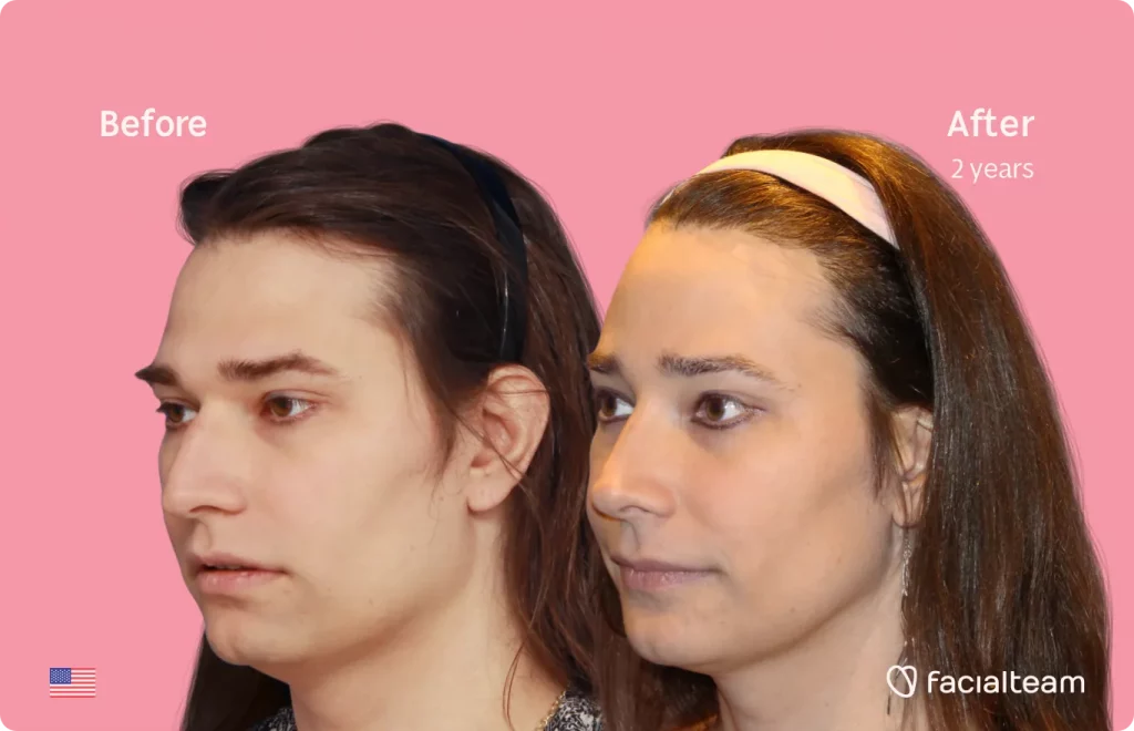 45 degree left image of FFS patient Lexi showing the results before and after facial feminization surgery consisting of jaw and chin, forehead, rhinoplasty feminization surgery.