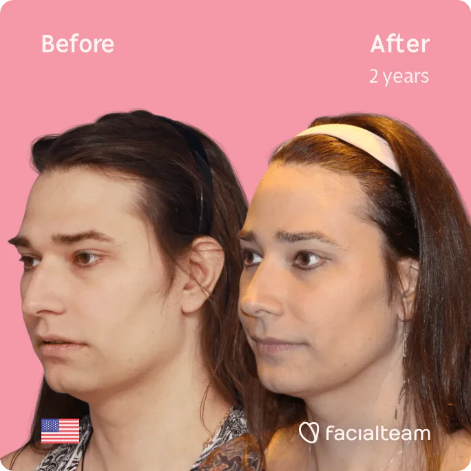 Square 45 degree left image of FFS patient Lexi showing the results before and after facial feminization surgery consisting of jaw and chin, forehead, rhinoplasty feminization surgery.