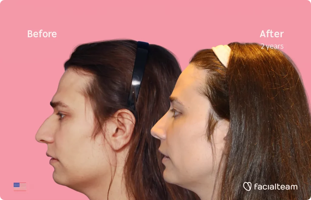 Left side image of FFS patient Lexi showing the results before and after facial feminization surgery with Facialteam consisting of jaw and chin, forehead, rhinoplasty feminization surgery.