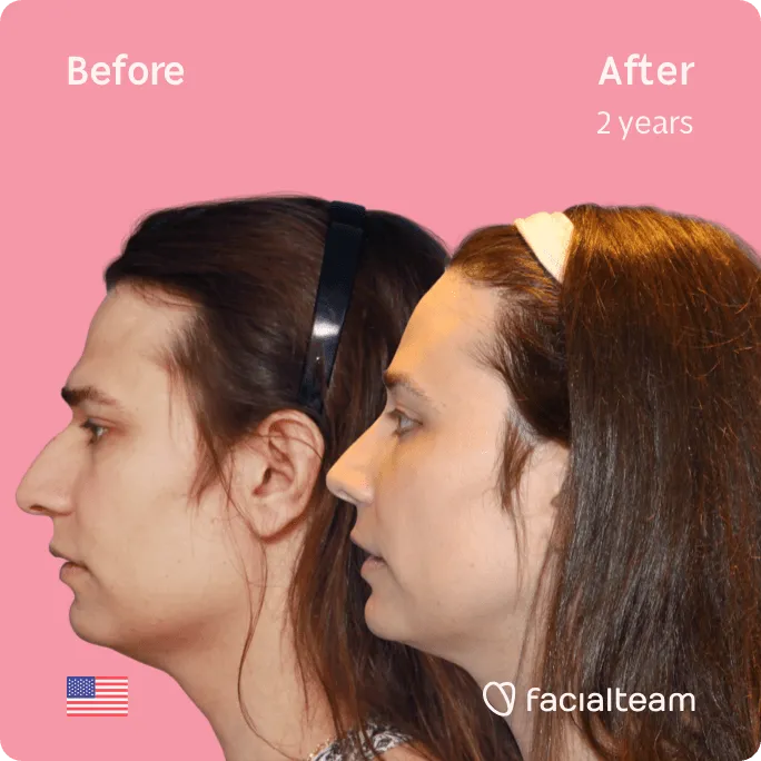 Square left side image of FFS patient Lexi showing the results before and after facial feminization surgery with Facialteam consisting of jaw and chin, forehead, rhinoplasty feminization surgery.