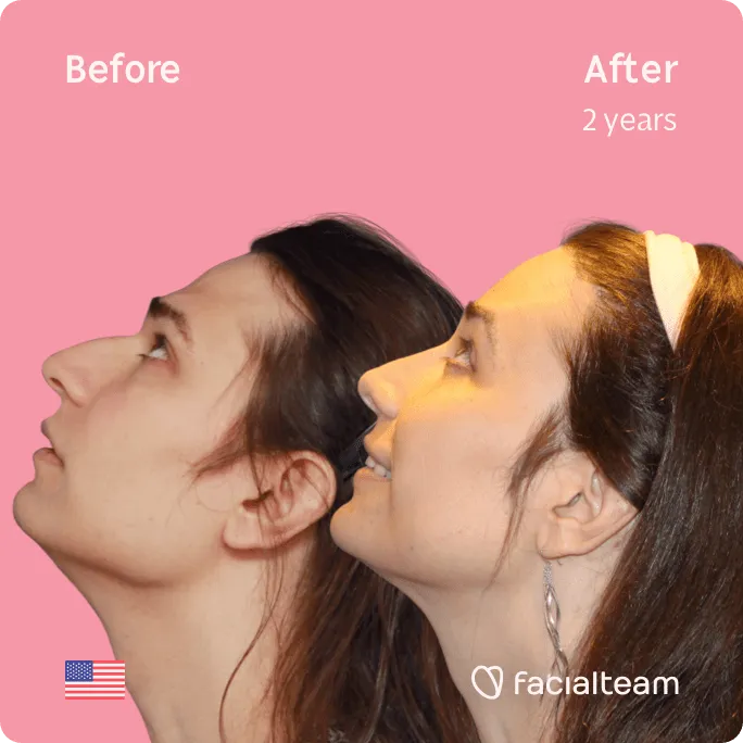 Square left side up image of FFS patient Lexi showing the results before and after facial feminization surgery with Facialteam consisting of jaw and chin, forehead, rhinoplasty feminization surgery.