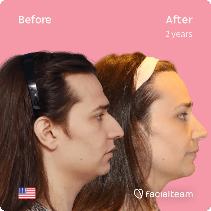 Square Side image of FFS patient Lexi showing the results before and after facial feminization surgery with Facialteam consisting of jaw and chin, forehead, rhinoplasty feminization surgery.