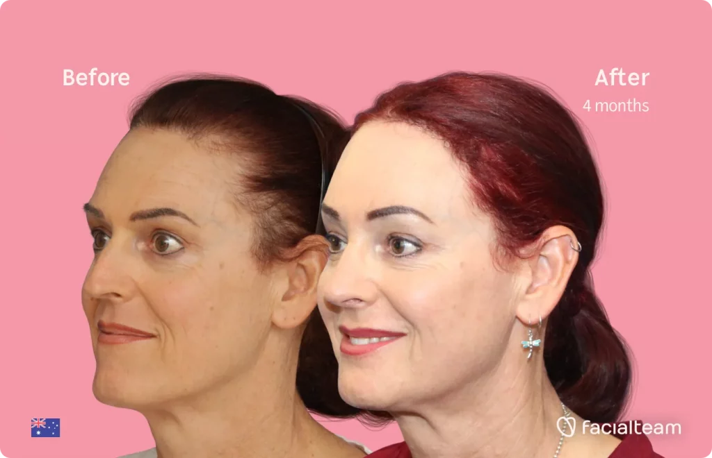 45 degree image of FFS patient Pippa showing the results before and after facial feminization surgery consisting of jaw and chin, forehead, rhinoplasty feminization surgery.