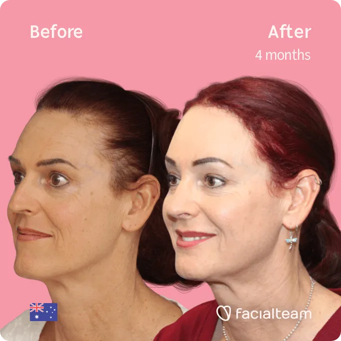 Square 45 degree image of FFS patient Pippa showing the results before and after facial feminization surgery consisting of jaw and chin, forehead, rhinoplasty feminization surgery.