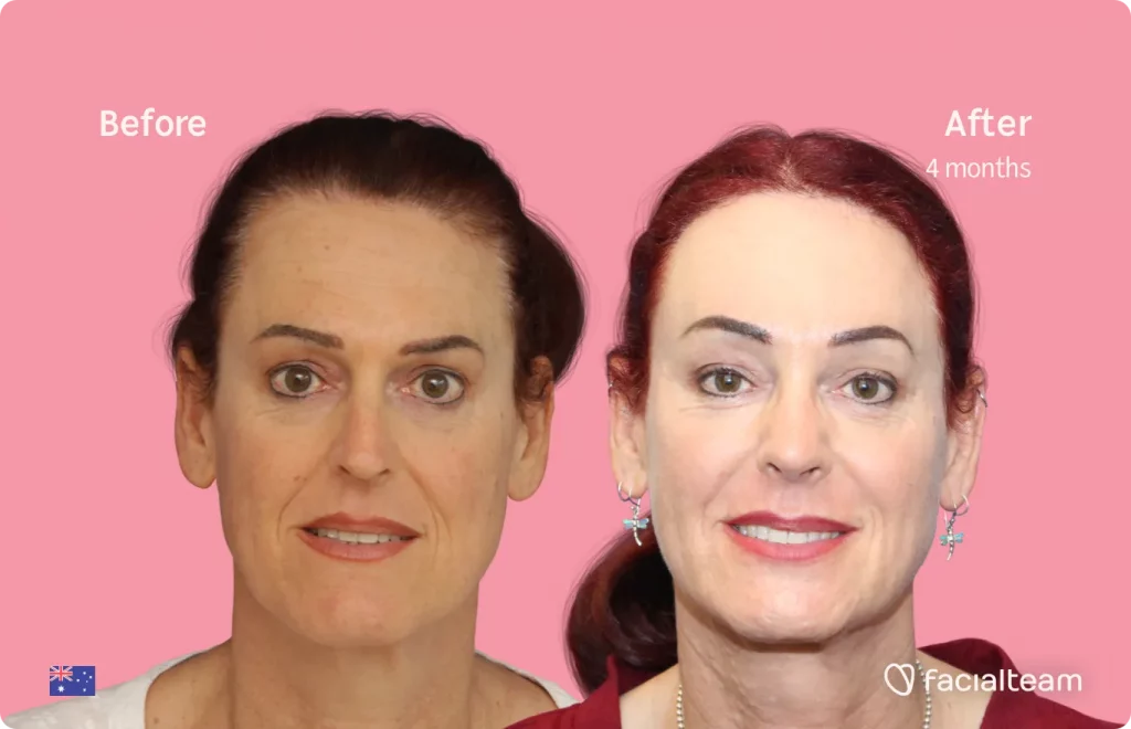 Frontal image of FFS patient Pippa showing the results before and after facial feminization surgery with Facialteam consisting of jaw and chin, forehead, rhinoplasty feminization surgery.