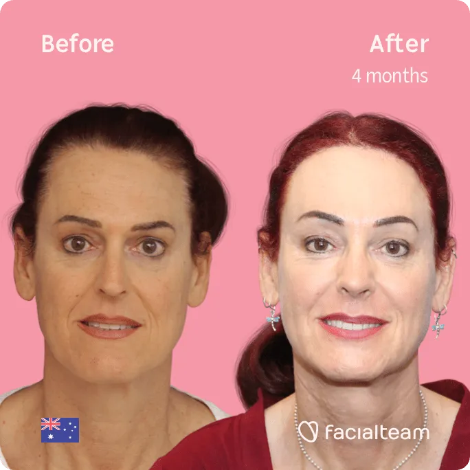 Square frontal image of FFS patient Pippa showing the results before and after facial feminization surgery with Facialteam consisting of jaw and chin, forehead, rhinoplasty feminization surgery.