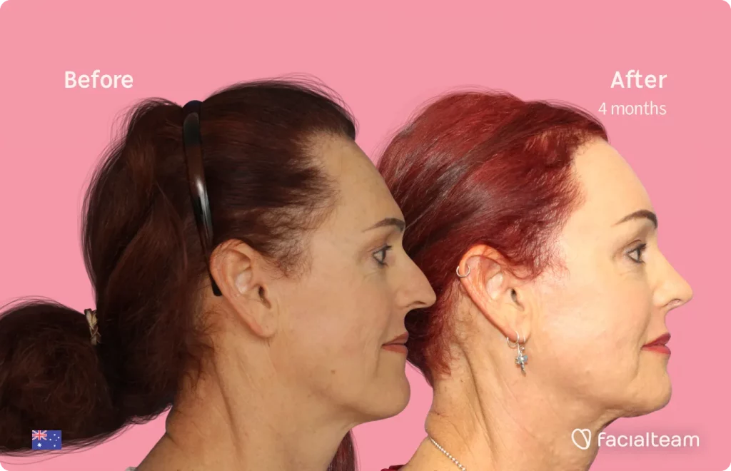 Side image of FFS patient Pippa showing the results before and after facial feminization surgery with Facialteam consisting of jaw and chin, forehead, rhinoplasty feminization surgery.