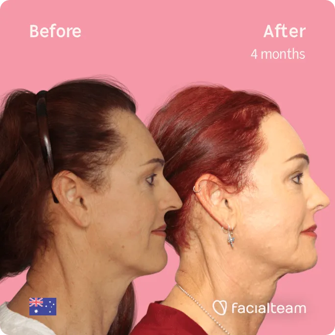 Square Side image of FFS patient Pippa showing the results before and after facial feminization surgery with Facialteam consisting of jaw and chin, forehead, rhinoplasty feminization surgery.