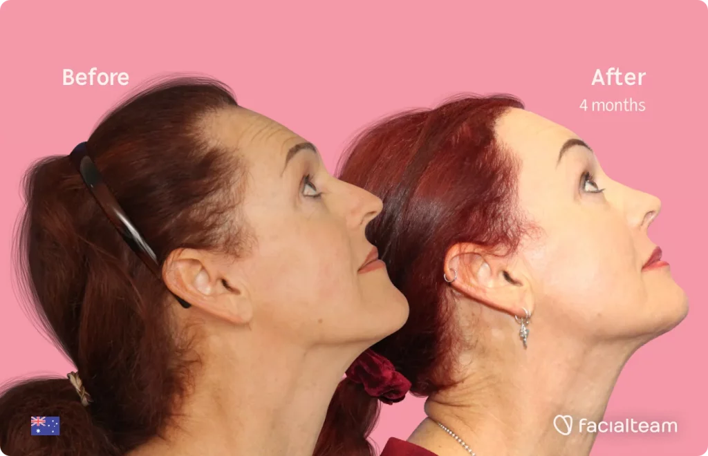 Side up image of FFS patient Pippa showing the results before and after facial feminization surgery with Facialteam consisting of jaw and chin, forehead, rhinoplasty feminization surgery.