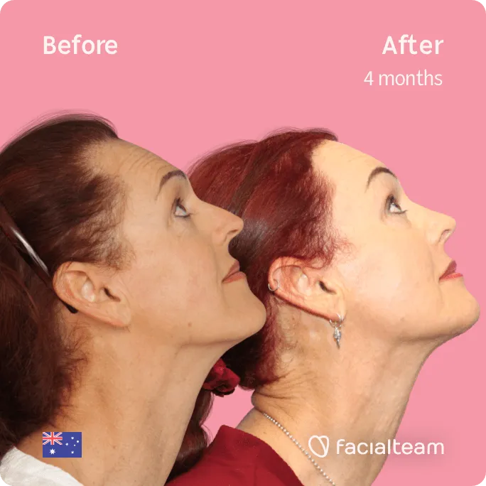 Square Side up image of FFS patient Pippa showing the results before and after facial feminization surgery with Facialteam consisting of jaw and chin, forehead, rhinoplasty feminization surgery.