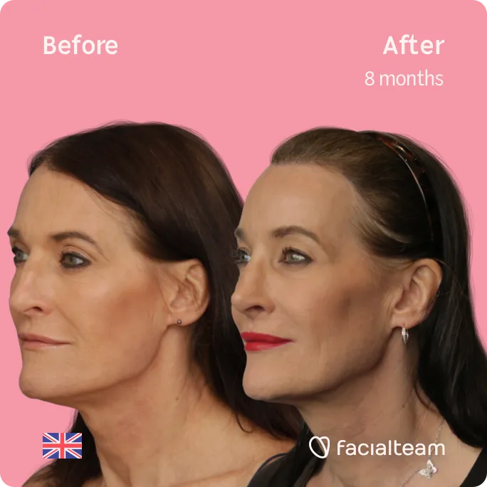 Square 45 degree image of FFS patient Susan showing the results before and after facial feminization surgery consisting of jaw and chin, rhinoplasty, forehead feminization surgery.