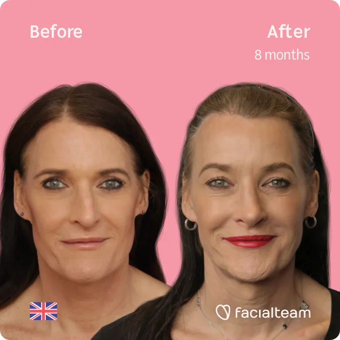 Square frontal image of FFS patient Susan showing the results before and after facial feminization surgery with Facialteam consisting of jaw and chin, rhinoplasty, forehead feminization surgery.