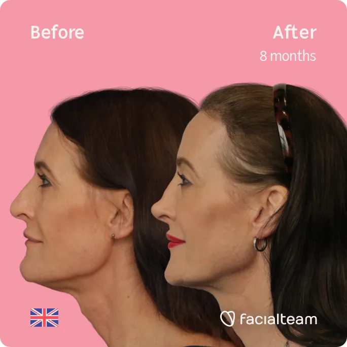 Square Side image of FFS patient Susan showing the results before and after facial feminization surgery with Facialteam consisting of jaw and chin, rhinoplasty, forehead feminization surgery.