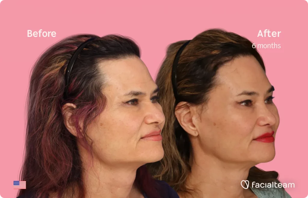 45 degree image of FFS patient Kendra showing the results before and after facial feminization surgery consisting of rhinoplasty, forehead, jaw and chin, lip feminization surgery.