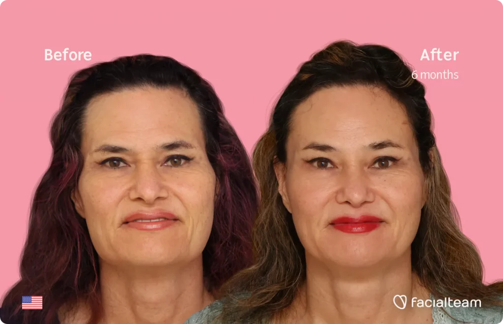 Frontal image of FFS patient Kendra showing the results before and after facial feminization surgery with Facialteam consisting of rhinoplasty, forehead, jaw and chin, lip feminization surgery.