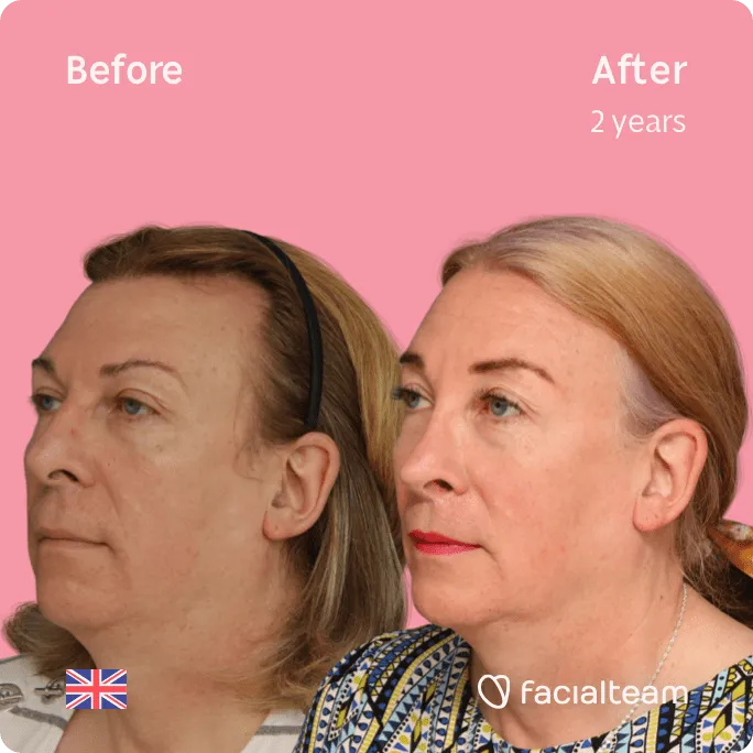 Square 45 degree image of FFS patient Stephanie showing the results before and after facial feminization surgery consisting of rhinoplasty, forehead, tracheal shave, lip feminization surgery.