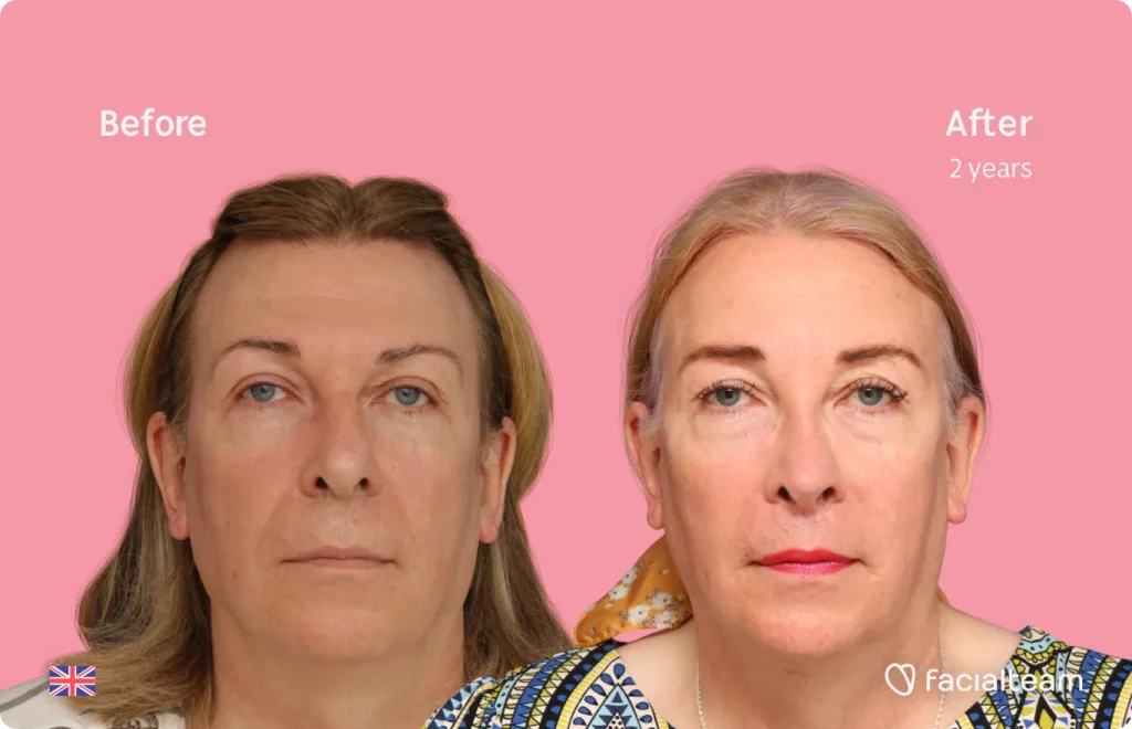 Frontal image of FFS patient Stephanie showing the results before and after facial feminization surgery with Facialteam consisting of rhinoplasty, forehead, tracheal shave, lip feminization surgery.