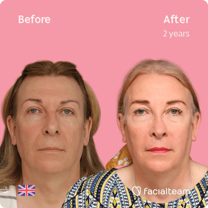 Square frontal image of FFS patient Stephanie showing the results before and after facial feminization surgery with Facialteam consisting of rhinoplasty, forehead, tracheal shave, lip feminization surgery.