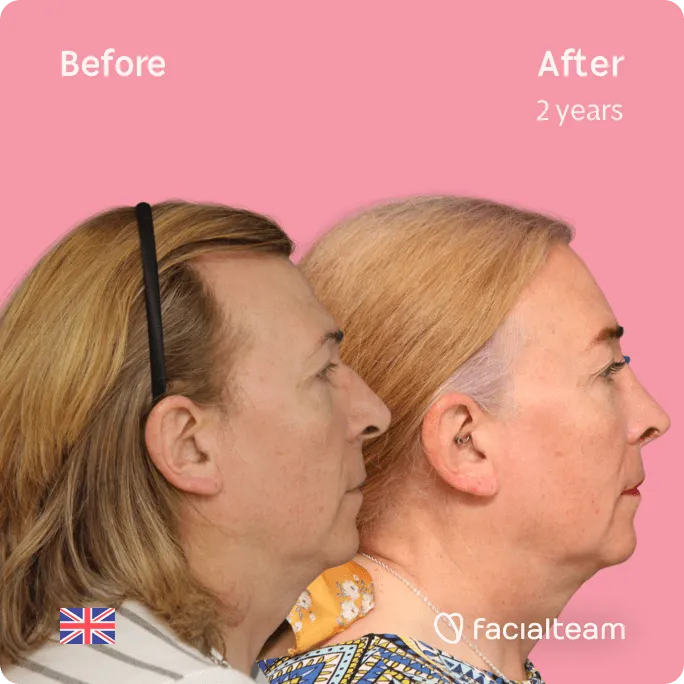 Square Side image of FFS patient Stephanie showing the results before and after facial feminization surgery with Facialteam consisting of rhinoplasty, forehead, tracheal shave, lip feminization surgery.