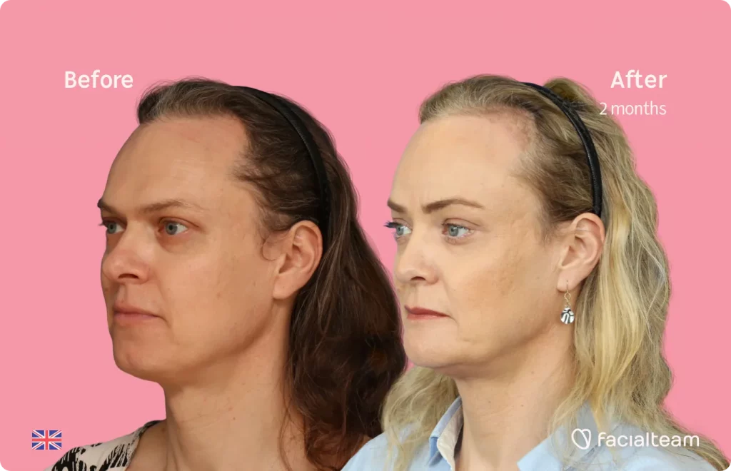 45 degree image of FFS patient Elle showing the results before and after facial feminization surgery consisting of rhinoplasty, jaw and chin, forehead feminization surgery.