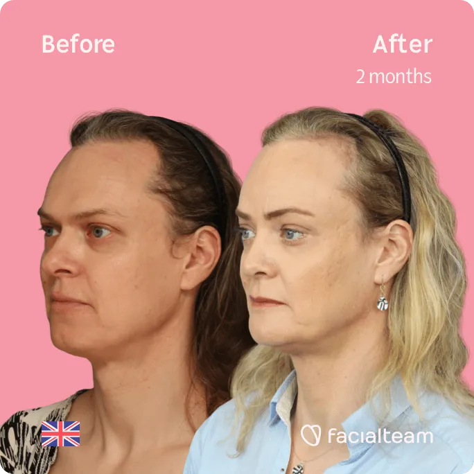 Square 45 degree image of FFS patient Elle showing the results before and after facial feminization surgery consisting of rhinoplasty, jaw and chin, forehead feminization surgery.